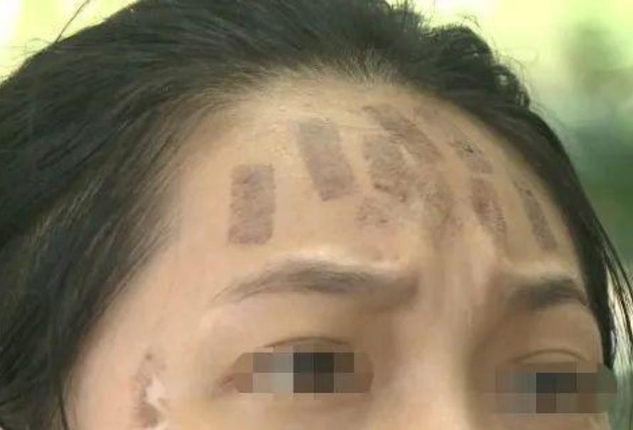 成都光子嫩膚價(jià)格，科技重塑肌膚之美